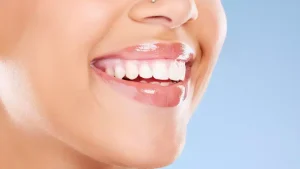 What Are Dental Laminates?