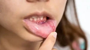 Mouth Sores: Symptoms, Treatment