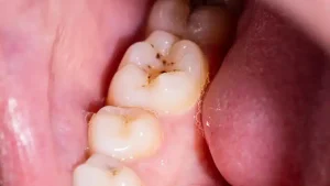 Dental Calculus (Tartar): Causes And Treatment
