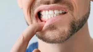 gum bleeding symptoms