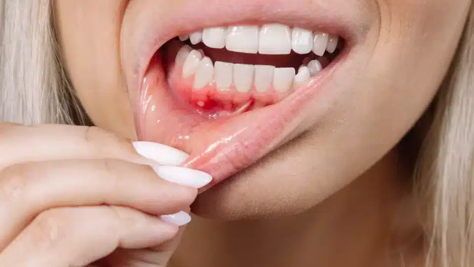 gum bleeding treatment