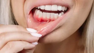 gum itching