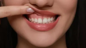 What Causes Gum Recession? Symptoms and Treatment