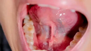 What Is Mouth Cancer? Causes And Symptoms