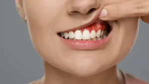 What Is Tooth Abscess? Symptoms And Treatments