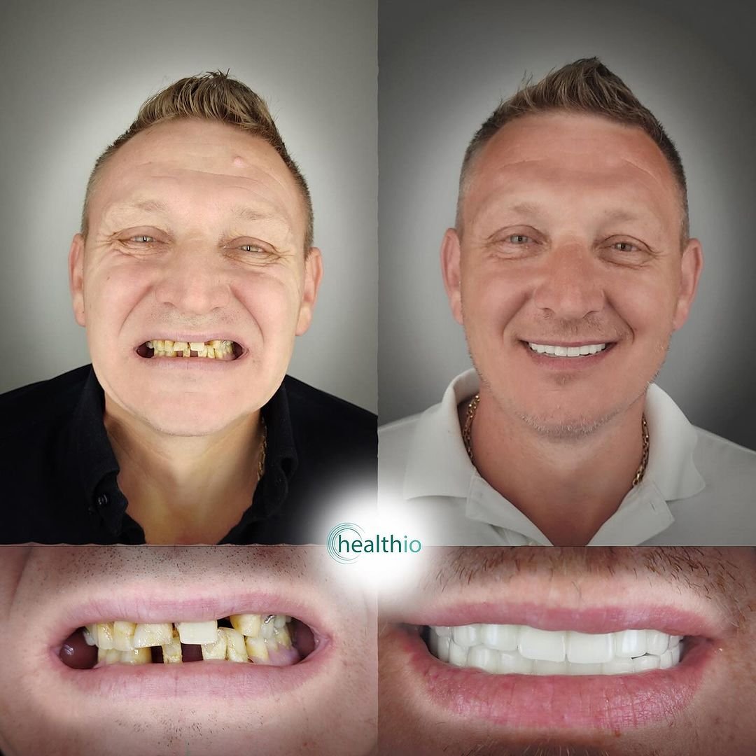 Teeth Whitining Antalya