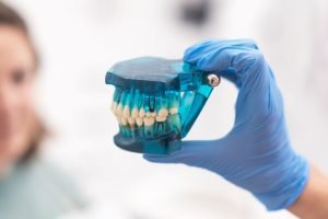 Why Choose Healthio Turkey for Your All on 4 Dental Treatment in Antalya
