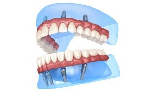 All on 6 Dental Implants in Antalya: Why Healthio Turkey Dental Clinic is the Best Choice